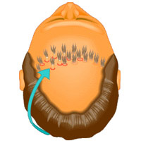 hair lose