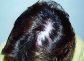 �icatricial_alopecia